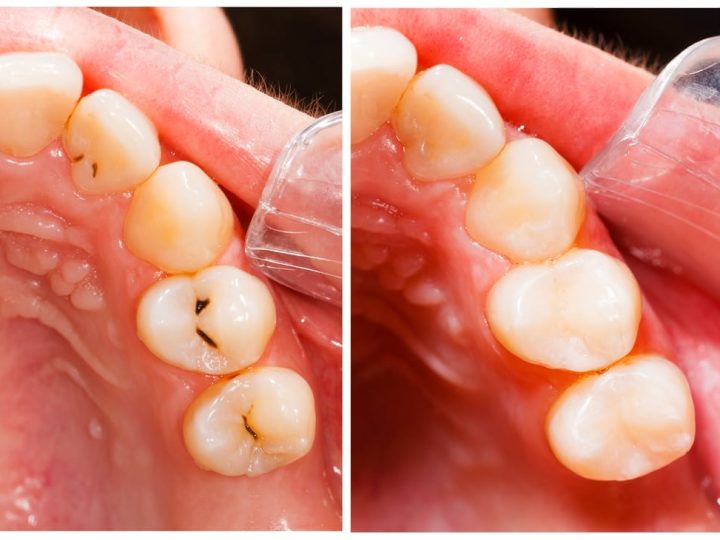 Tooth-Colored Fillings in Goldsboro, NC