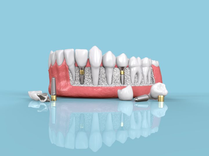 Dental Implants in Goldsboro, NC
