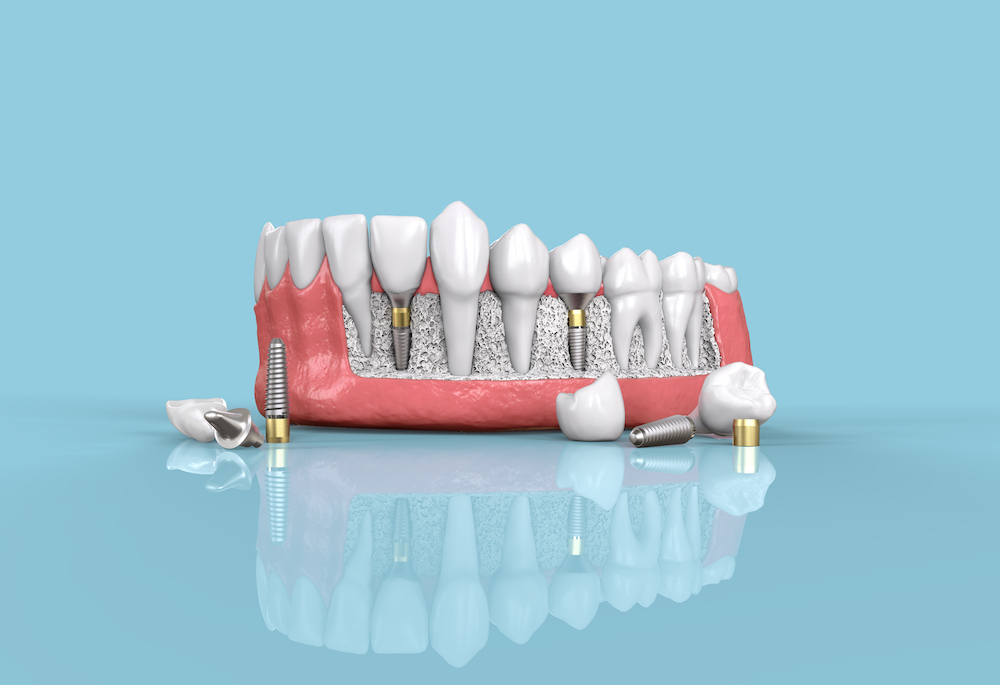 dental implants in Goldsboro, NC