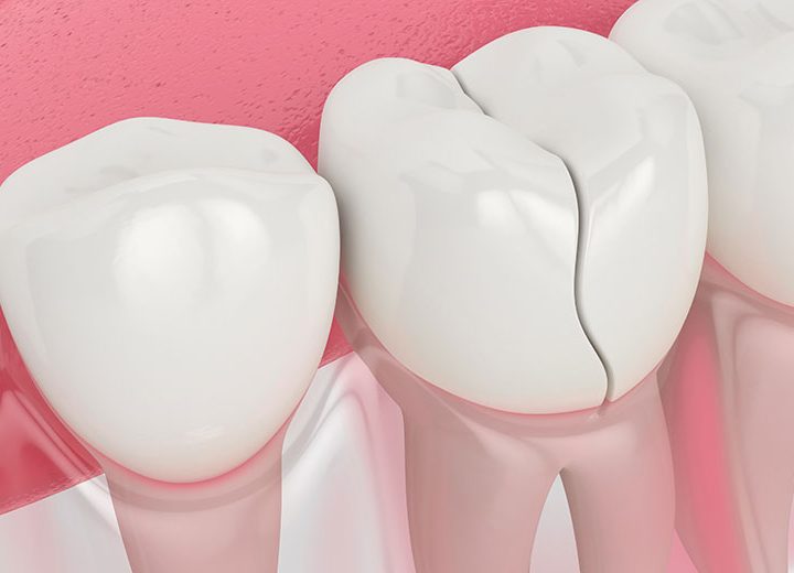 Cracked Teeth: A Comprehensive Guide To Causes, Symptoms, And Treatments