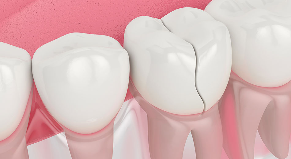 cracked tooth