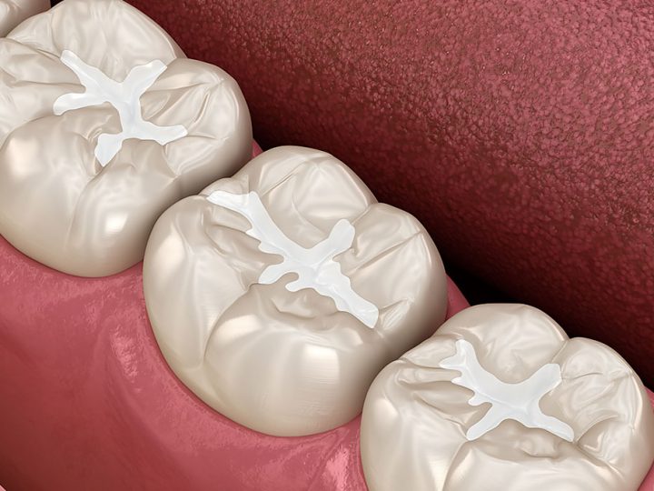 Dental Sealants