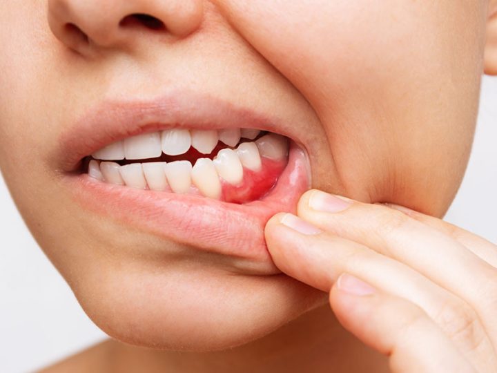 The Silent Progression of Gum Disease: Early Warning Signs You Shouldn’t Ignore