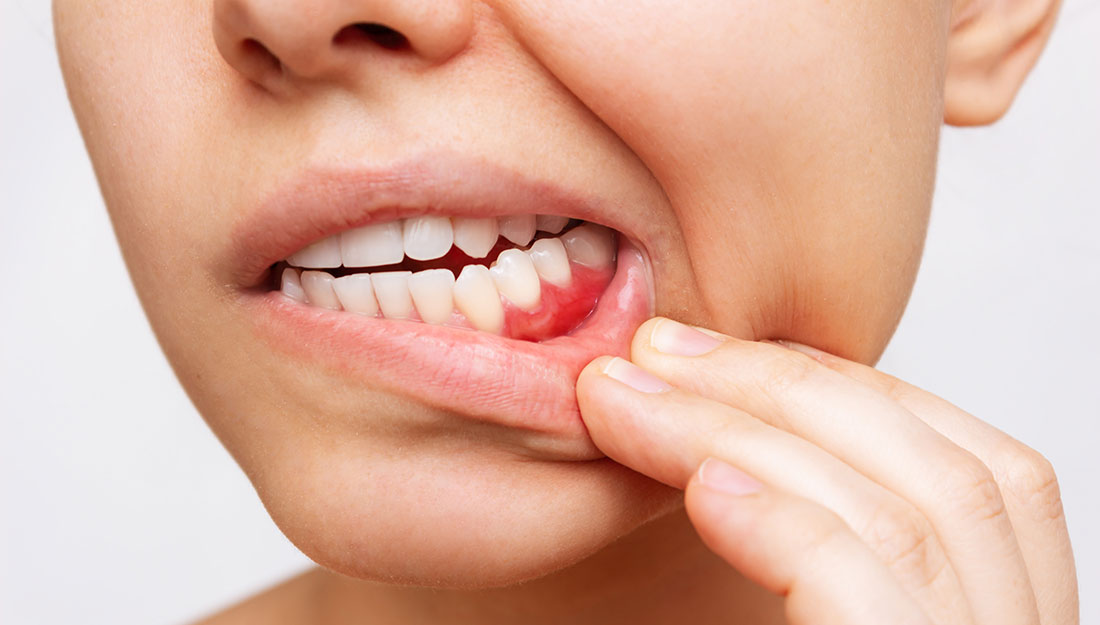 gum disease signs