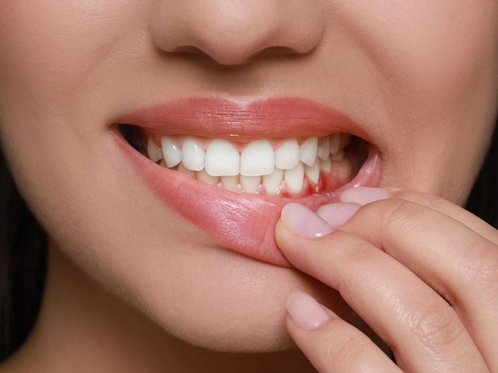 Signs You Might Have Periodontal Disease (And What to Do About It)