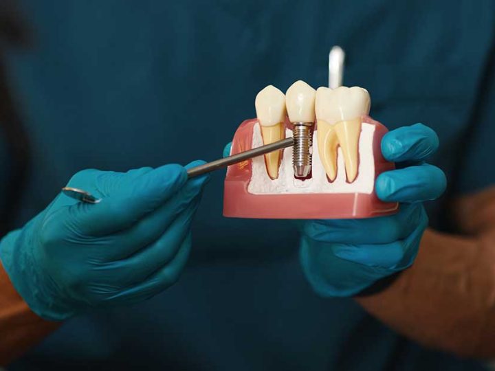 The Hidden Consequences of Leaving a Missing Tooth Untreated