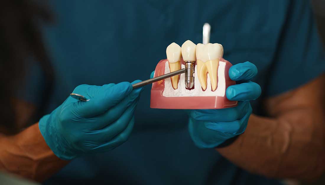 dental implants in Goldsboro, NC